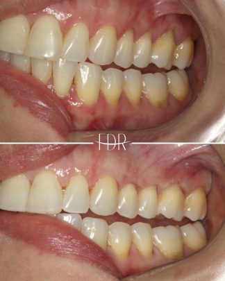 Foto de caso de Correção das retrações gengivais