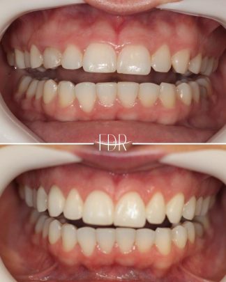 Correção do sorriso gengival