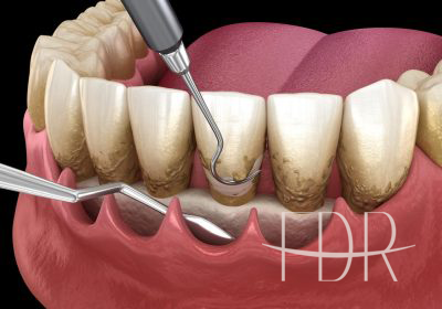 Tratamento-Periodontal